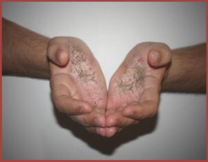 Hand Fungus