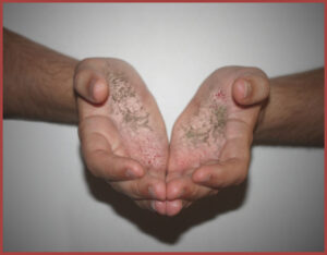 Hand Fungus