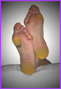 Foot Corns